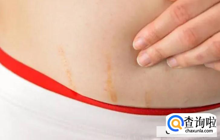 用青柠汁多久去妊娠纹