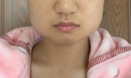 长智齿会把脸撑大吗