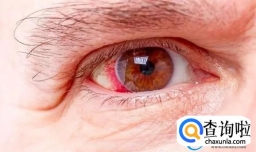 感染后眼睛疼怎么办