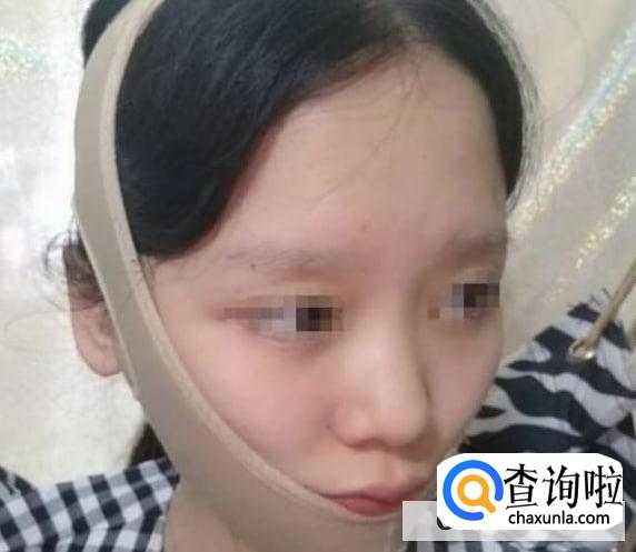 下颌角手术头套带多久