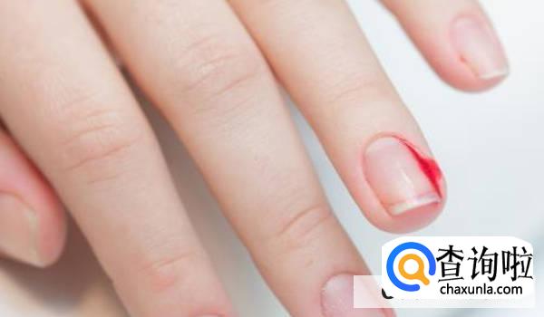 为什么倒刺虽小处理不好会出大问题