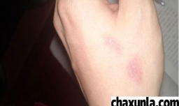 烫伤后你还在用冰块冷敷吗？