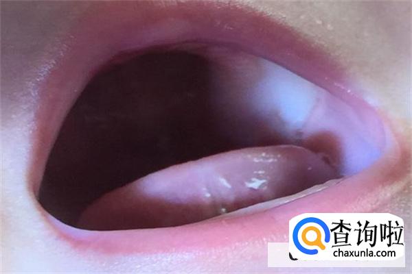 宝宝上颚发白怎么回事