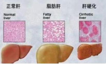 脂肪肝最好的治疗方法