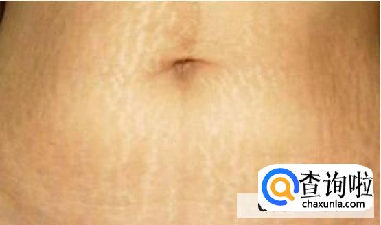 女孩子没怀过孕会有妊娠线吗