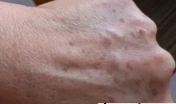 老年斑可以预防吗