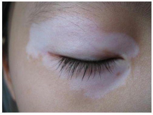 脸上长白斑是缺什么维生素