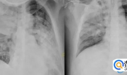 新冠发烧对肺有影响吗 会出现白肺吗