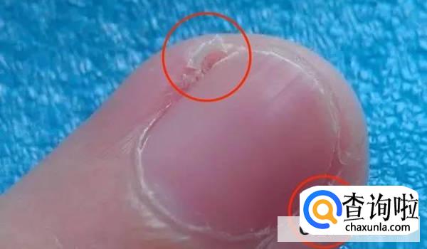 为什么倒刺虽小处理不好会出大问题