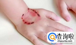 孩子被幼儿园同学咬，该打针吗