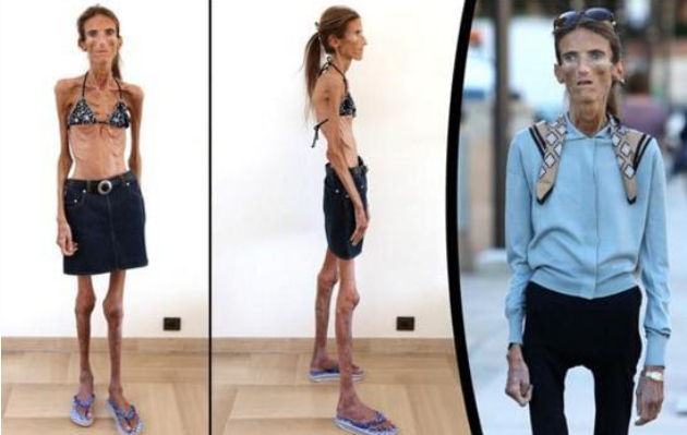 世界上最瘦的人