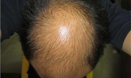 怎么才能减少掉发