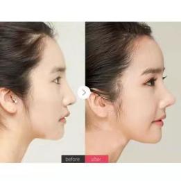 怎么让鼻子变高