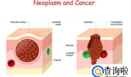 哪些肿瘤是良性的，哪些是恶性的？如何区分？