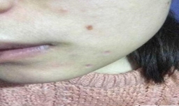 产后多久可以点痣