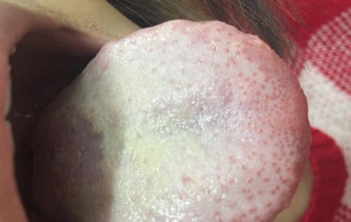 宝宝舌苔厚白是怎么回事