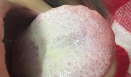 宝宝舌苔厚白是怎么回事