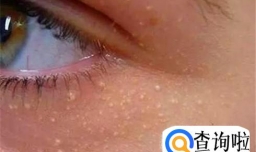 三个小妙招帮你去除脂肪粒