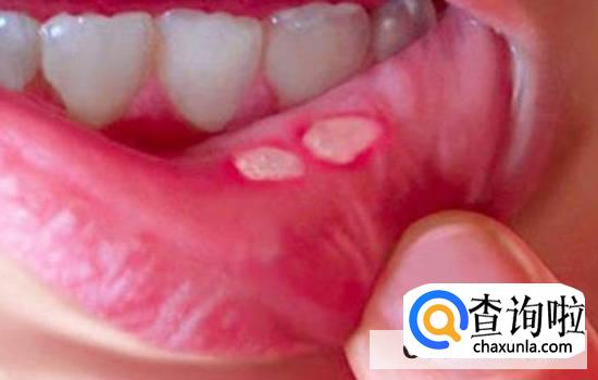 口腔溃疡怎么处理