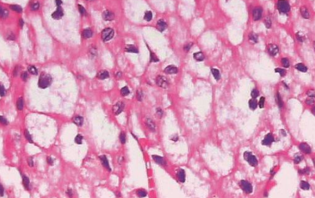 什么是嫌色细胞癌