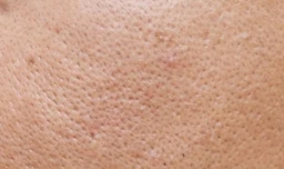 男生会出现毛孔粗大吗