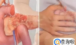 从“炎症”到“癌症”要几年时间？医生：这5种炎症，请尽早治疗