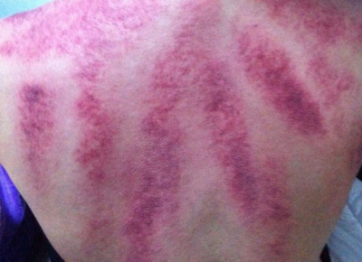 刮痧多久可以洗澡