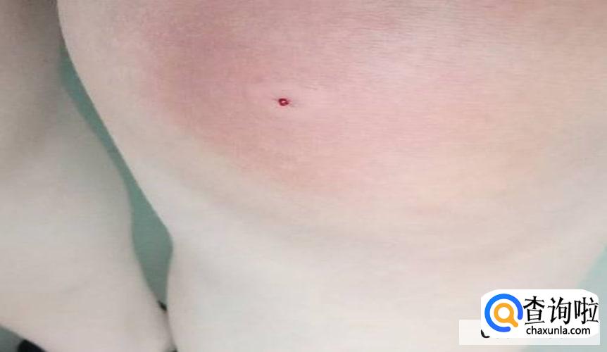 被蜂子蛰了怎么办