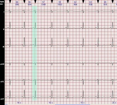 早搏是什么意思