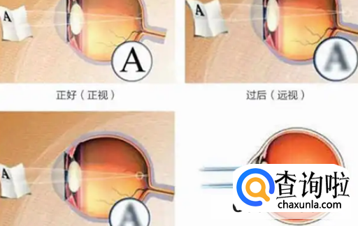 如何预防儿童屈光不正