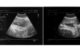 普通B超、彩超、三维彩超和四维彩超区别及选择
