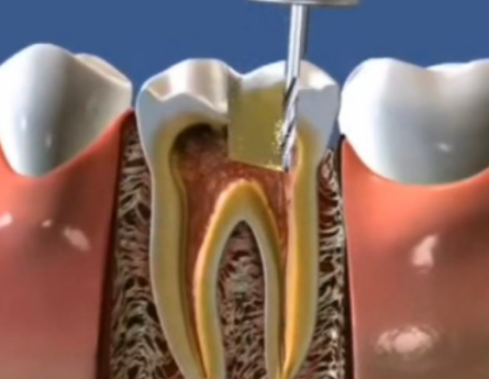 如何判断自己是否需要做根管治疗