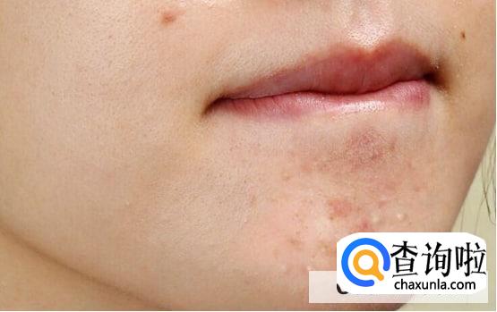下巴长痘痘是什么火