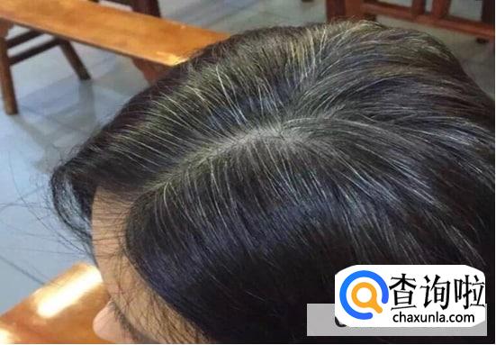 产生白头发原因有哪些