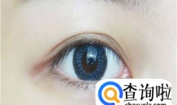 做双眼皮手术多久才能恢复？