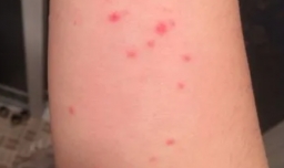 身上长红点是什么原因呢？干万不要掉以轻心