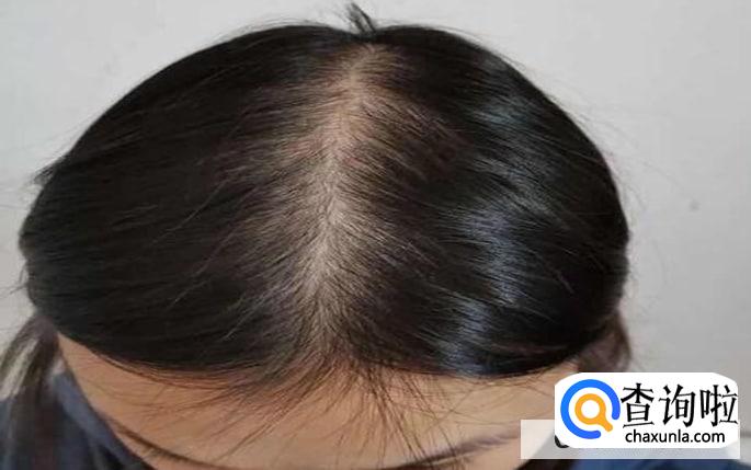14岁发际线怎么养回来