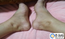 每天下午脚肿了早上就好的原因