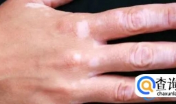 白斑是什么原因导致的