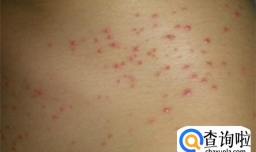 男性念珠菌病一辈子就完了吗