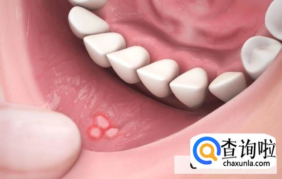 口腔溃疡怎么处理