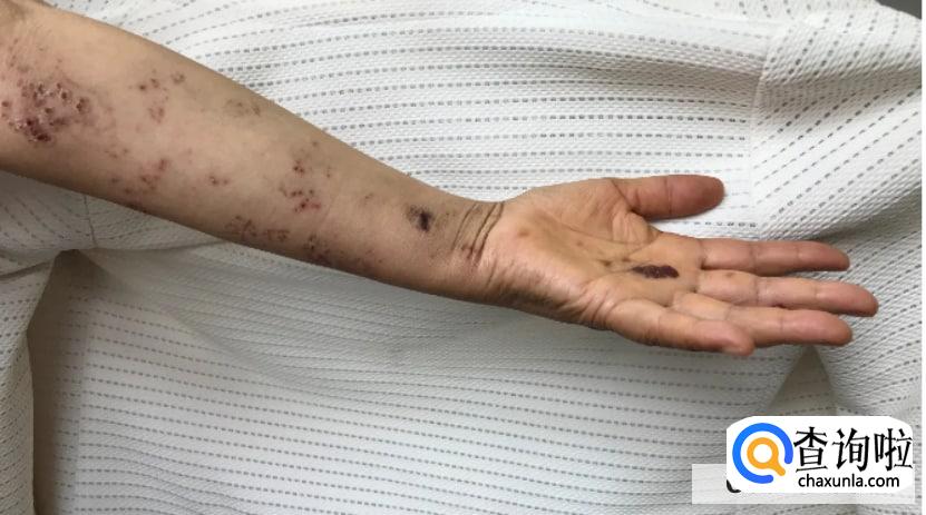 怎么诊断带状疱疹?