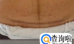 剖腹产伤口怎么护理