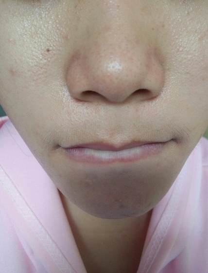 鼻子黑毛跟黑头的区别