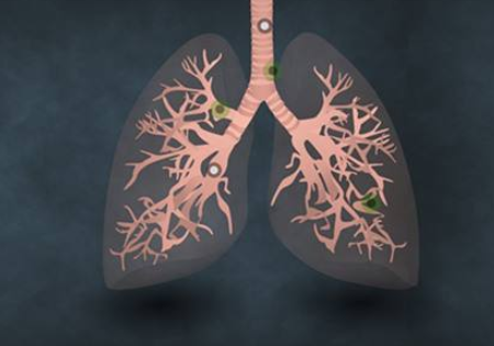 晚期肺癌的如何控制病情