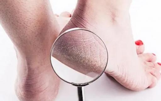 脚后跟干裂如何保养及护理