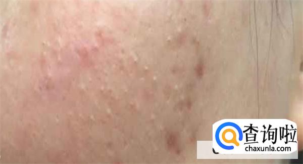 维生素B2可以祛痘吗