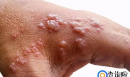 手脱皮严重是什么原因导致的