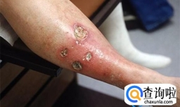 皮肤溃疡久不愈合的原因是什么