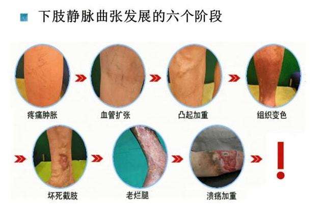 静脉曲张怎么治疗？最好的方法有哪些？